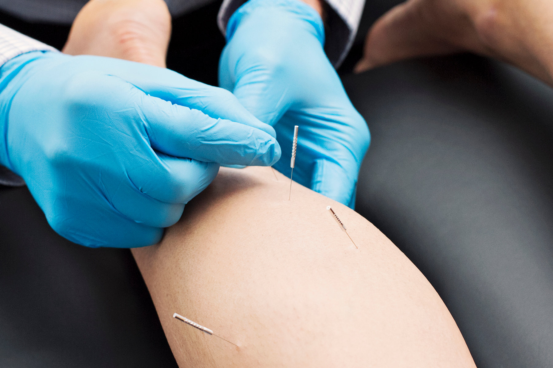 Dry Needling
